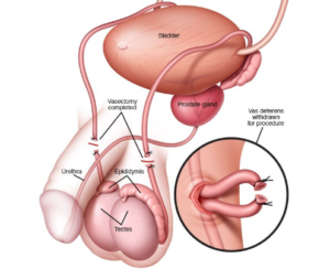 Tudo o que você precisa saber sobre Vasectomia